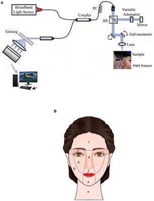 Hemoporfin-Mediated Photodynamic Therapy for Port-Wine Stains: Multivariate Analysis of Clinical Efficacy and Optical Coherence Tomography Appearance